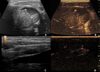 Value of Contrast-Enhanced Ultrasound in the Preoperative Evaluation of Papillary Thyroid Carcinoma Invasiveness